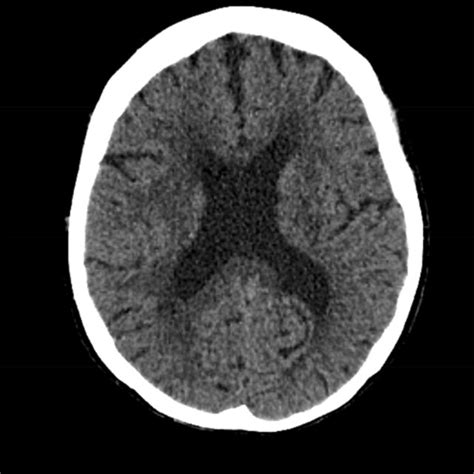 Initial Computed Tomography CT Without Contrast Demonstrating No