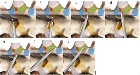 Sublaminar Contralateral Interlaminar Foraminotomy A Start Drilling Download Scientific