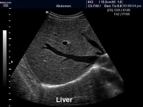 Pancreas Ultrasound Of Liver Gallbladder And Pancreas