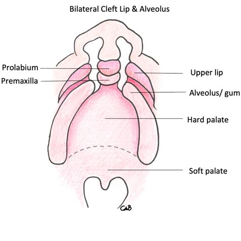 Different types of cleft explained . Cleft Lip & Palate Explained . Cleft Care Ireland