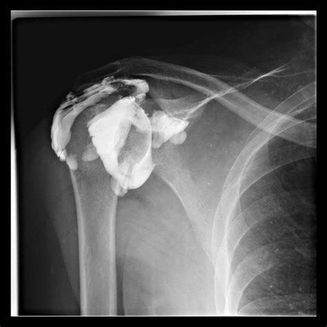 Rotator Cuff Tear MRI