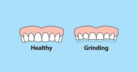 How Teeth Grinding Can Affect Your Oral Health Royal Dental Clinics Blog