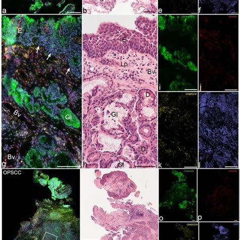 Comparison between patients with oropharyngeal squamous cell carcinoma ...