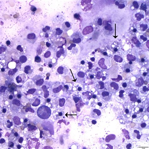 Figure 1C: Peritoneal fluid | eClinpath