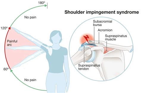 Shoulder Impingement Syndrome Test