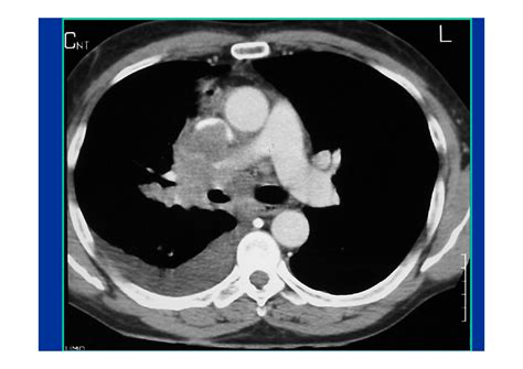 Solution Scanner Thoracique Anatomie Du Thorax En Coupes Studypool