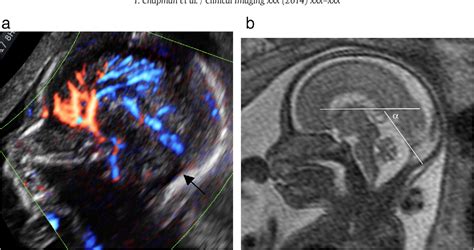 Figure 5 From Diagnostic Imaging Of Posterior Fossa Anomalies In The