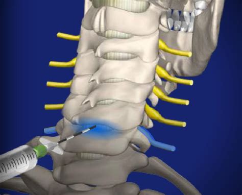 Cervical Spine Epidural Injection