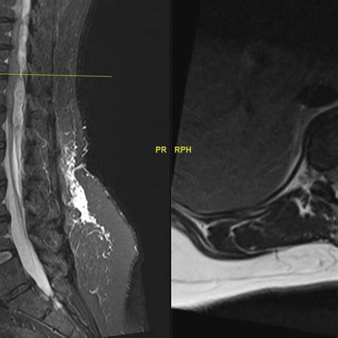 Post Operative Mri Whole Spine Download Scientific Diagram