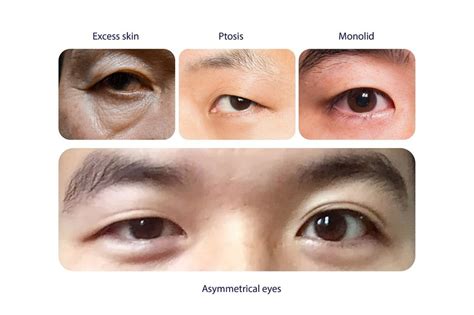 Four Reasons To Get Double Eyelid Surgery Dream Plastic Surgery