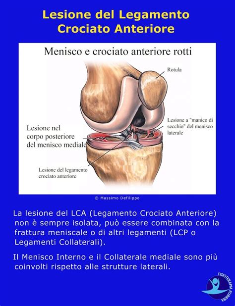 Lesione Del Menisco E Dei Legamenti Sintomi Cura E Tempi Di Recupero