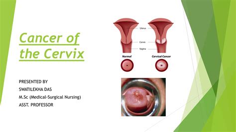 Cancer Of Cervix Easy Ppt For Nurses Ppt