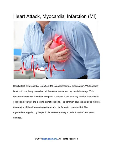 Heart and Aorta - Heart Attack or Myocardial Infarction (MI) - Page 1