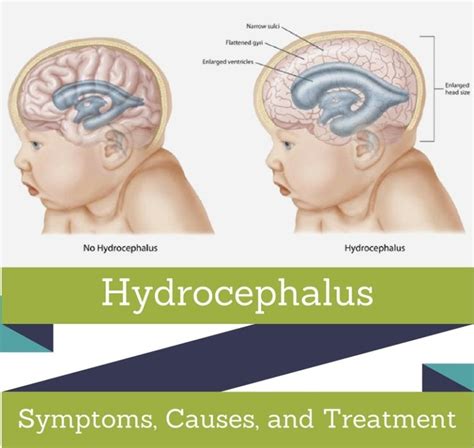 Hydrocephalus In Adults Neryfone