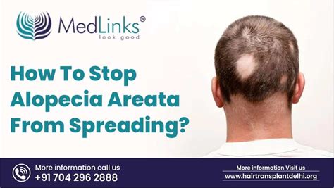 How To Stop Alopecia Areata From Spreading Medlinks