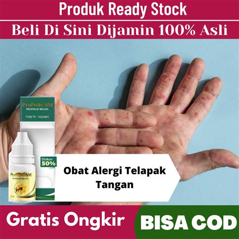 Jual Obat Alergi Telapak Tangan Bentol Berair Di Telapak Tangan