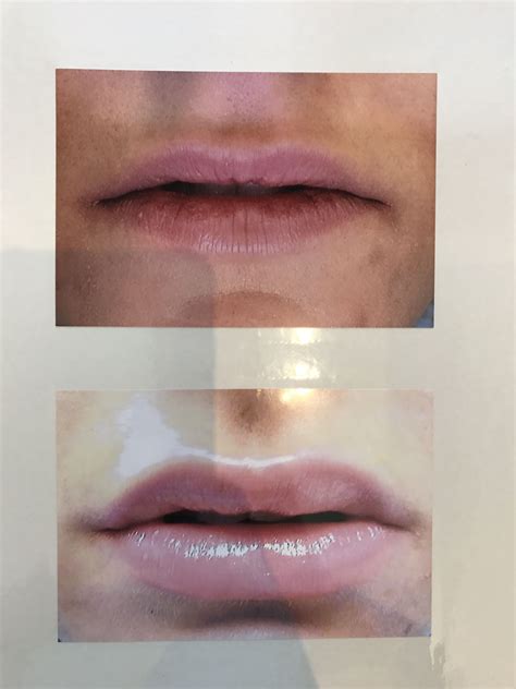 Diy Lip Filler At Home Merna Sawyer