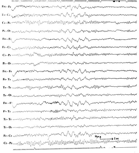 Intermittent Rhythmic Delta Activity Irda Morphology Cannot