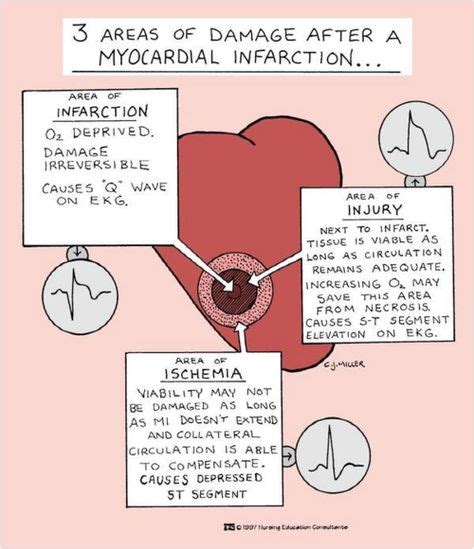 28 Nursing Myocardial Infarction Mi Ideas Myocardial Infarction