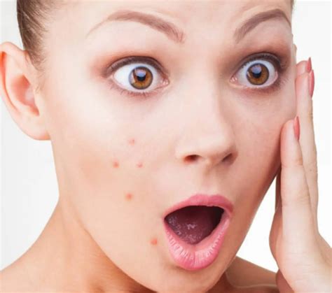 6 Best Home Remedies To Get Rid Of Acne Effectively Manipalblog