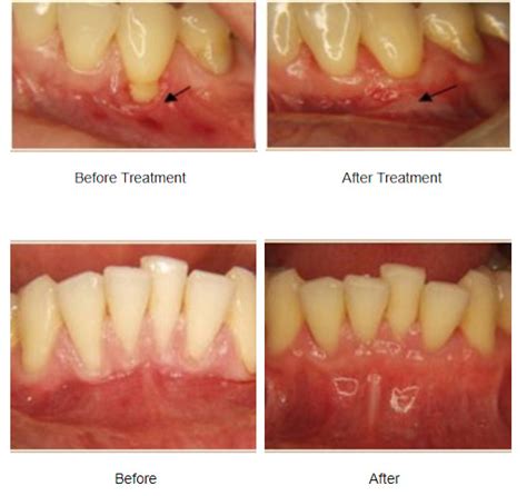 best Gum Recession Repair in Orange County