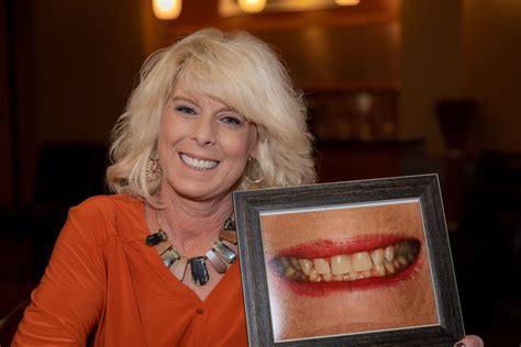 All On Dental Implants A Game Changer In Restorative Dentistry