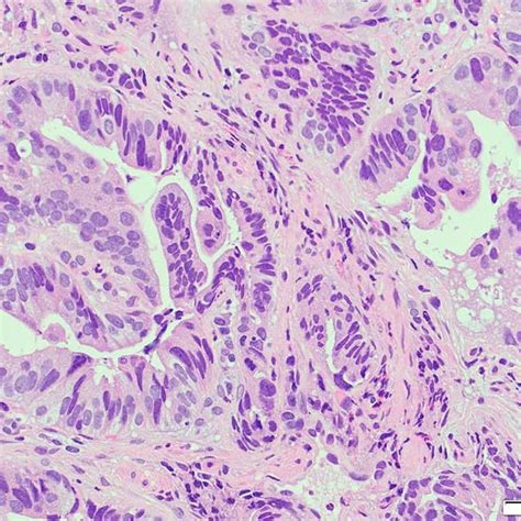 Hematoxylin And Eosin Staining Of The Biopsy Specimen Of The Tumor