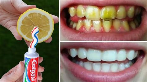 Teeth Whitening At Home In 3 Minutes How To Naturally Whiten Your Yellow Teeth 100