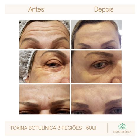 Toxina Botulínica 3 Regiões 50ui Natu EstÉtica