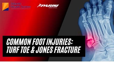 Common Foot Injuries Turf Toes And Jones Fractures Jones Fracture