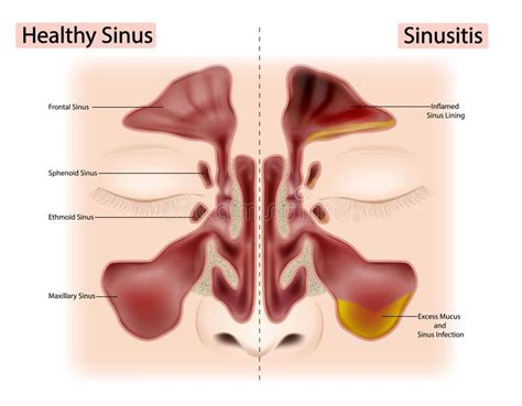 Healthy Sinus And Sinusitis Or Rhinosinusitis Excess Mucus And Sinus