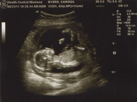 4 Month Sonogram Flickr Photo Sharing