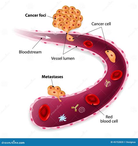 Metastasis. Metastases Cartoon Vector | CartoonDealer.com #72369455