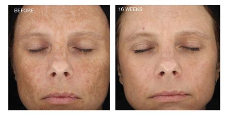 Anti Aging Program Anewskin Aesthetic Clinic And Medical Spa