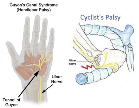 Ulnar Tunnel Syndrome Test