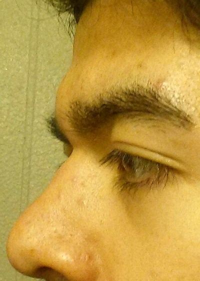 I Have A Horizontal Glabellar Crease Between My Eyes What Procedure