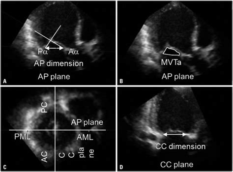 Illustrations Explaining Geometric Measurements Of The Mitral Tethering Download Scientific