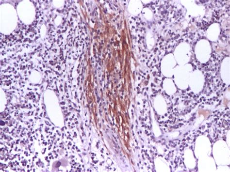 Aberrant Expression Of Cd25 In Malignant Mc Ihc Stain For Cd25 Ob