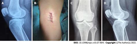 Avulsion Fracture Knee