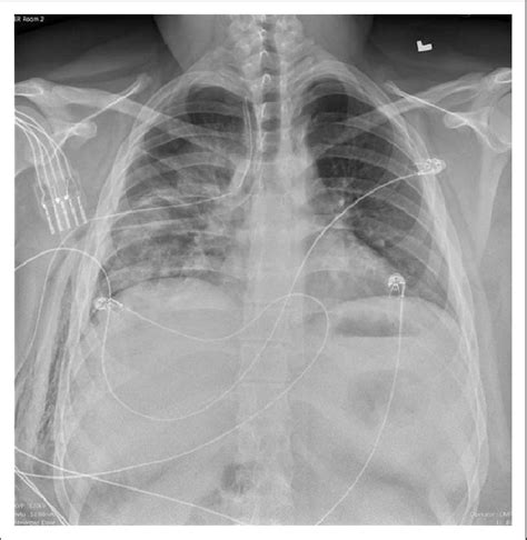 Chest Tube Placement For Pneumothorax