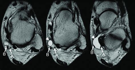 Tarsal Tunnel Syndrome Caused By Ganglion Cyst Axial T2 Weighted Image Download Scientific