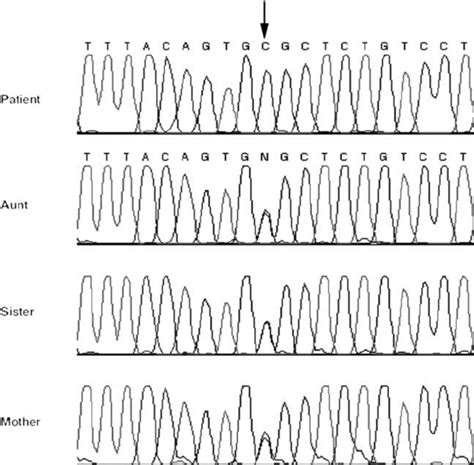 Direct Sequencing Of Thtr Gene Reveals G C Homozygous Mutation