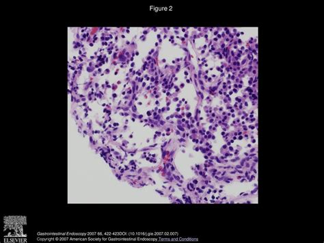 Eus Guided Tru Cut Biopsy For Serous Cystadenomas Of The Pancreas Ppt