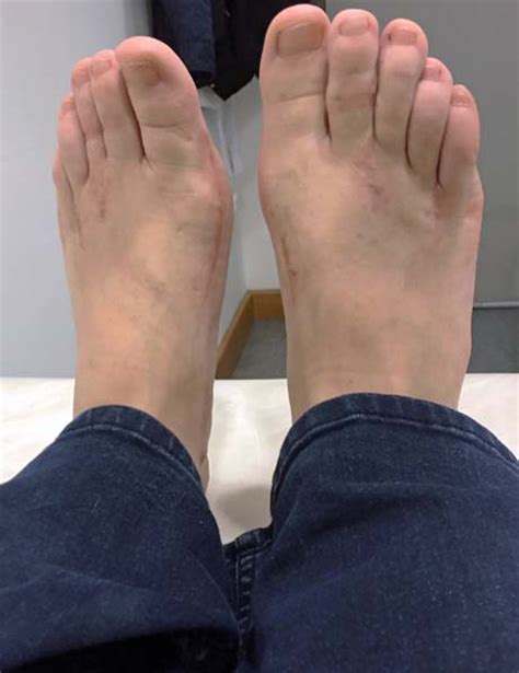 Hallux Valgus Bunion George D Goudelis Md Ph D