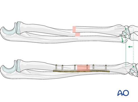 JPeei Clinic — Galeazzi Fracture Causes, Classification and...