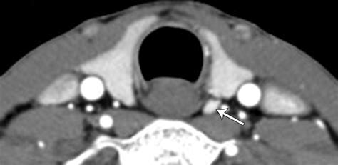 Parathyroid Adenomas And Hyperplasia On Four Dimensional Ct Scans