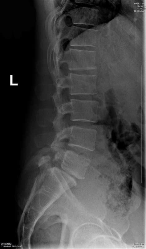 How much slippage? : r/Spondylolisthesis