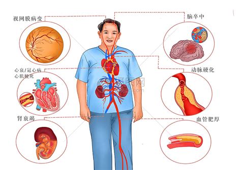 高血压主要危害医疗插画插画图片下载 正版图片401802089 摄图网