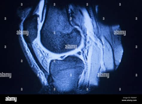 Resonancia Magn Tica Mri Exploraci N M Dica Mostrando Los Resultados De