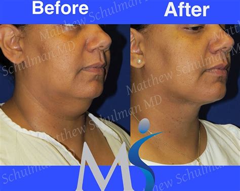 Chin Liposuction Brooklyn Ny Schulman Plastic Surgery